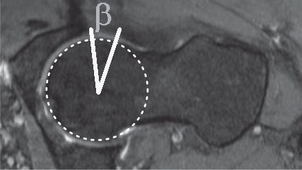 Beta angle of Wyss