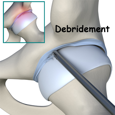 Labral resection